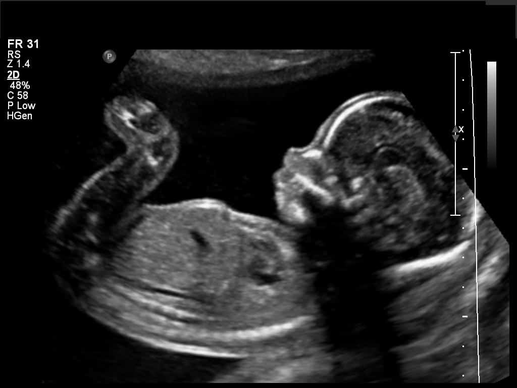 2nd-trim-fetus