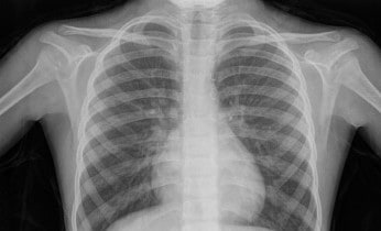 chest-x-ray