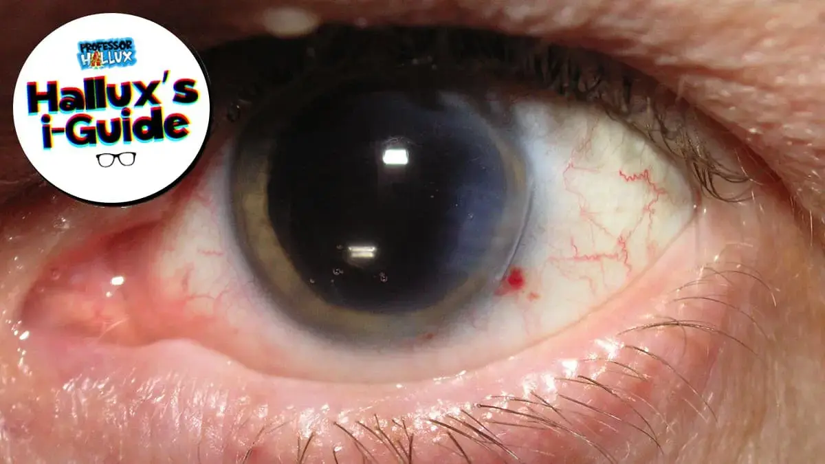 Hallux’s i-Guide: What are cataracts?
