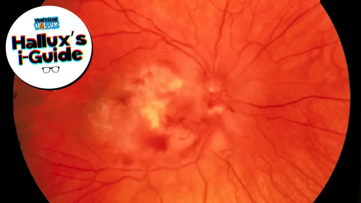 Hallux’s i-Guide: Vitreous