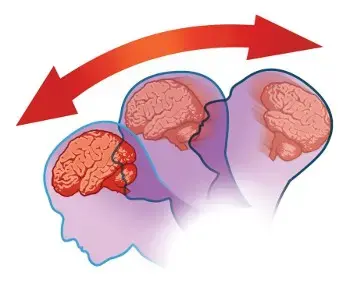 concussion-illus-350x283